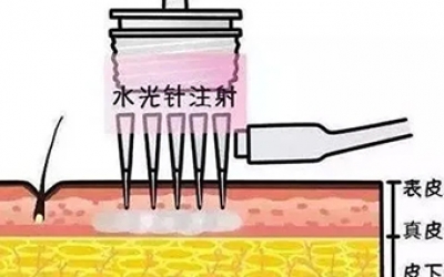 水光針的類型有哪幾種？