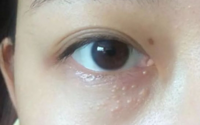 為什么眼部容易長脂肪粒？