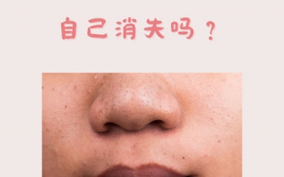 什么是黑頭？怎樣預(yù)防黑頭的形成？